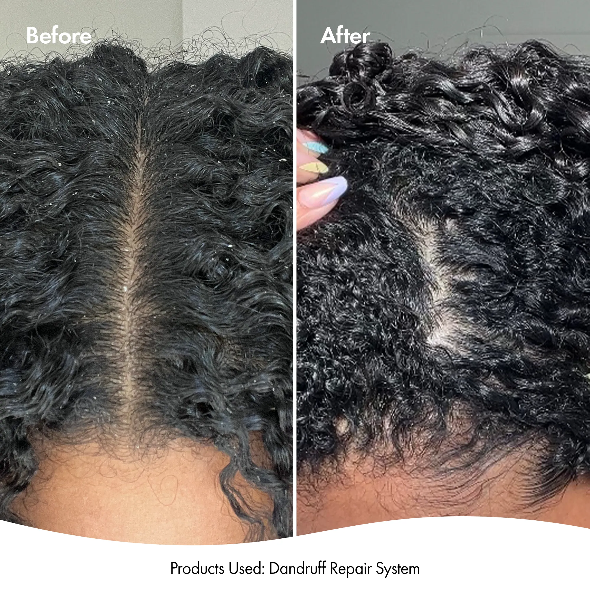 DRY   ITCHY SCALP SPRAY